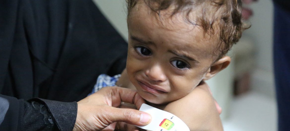也门一个名叫艾哈迈德的三岁男孩在医院接受中度急性营养不良治疗。粮食署图片/Abeer Etefa