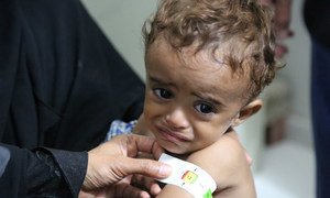 Ahmed, 3 years old, receives treatment for moderate acute malnutrition in a hospital in Hajjah, Yemen.