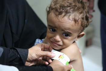 In the photo: Ahmed, 3 years old, receives treatment for moderate acute malnutrition in a hospital in Hajjah, Yemen.