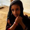 طفلة يمنية عمرها 5 سنوات، مصابة بسوء التغذية في مزرق باليمن.
