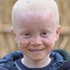 Niño con albinismo. Foto de archivo: UNICEF Mozambique/Sergio Fernandez