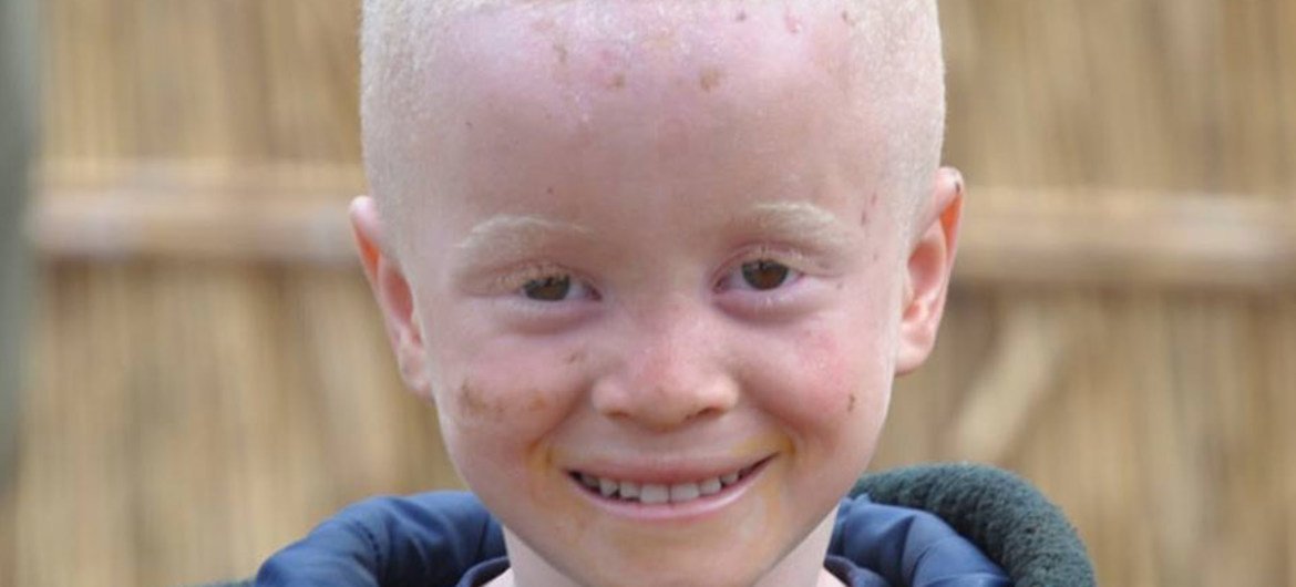 Children with albinism are often abused in Africa.
