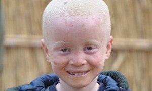 Les enfants atteints d'albinisme sont souvent victimes de discriminations en Afrique. Photo UNICEF Mozambique/Sergio Fernandez