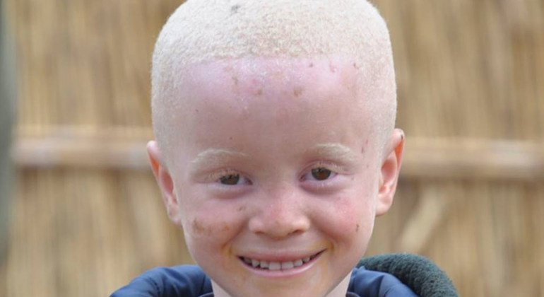 Salif Keita mwanamuziki kutoka mali ni Albinism kama huyo mtoto huyo.Albinism kawaida wanatendewa vibaya barani Afrika.