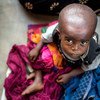 Un enfant souffrant de malnutrition attend d'être soigné dans un centre de santé dans la province du Kasaï oriental en République démocratique du Congo - une région en proie à un conflit entre la milice du chef traditionnel Kamuina Nsapu et les forces arm