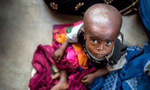 On May 19th, 2017, a child suufering from malnutrition is awaiting treatment in a health center in the province of Kasai Orientale in the Democratic Republic of the Congo, a region plagued by conflict between the militia of the traditional leader Kamuina Nsapu and the Government Armed Forces. © UNICEF/UN064921