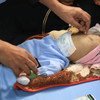 也门一所医院罹患严重急性营养不良的男孩。