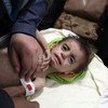 Dans la Ghouta orientale, en Syrie, un enfant est examiné par un professionnel de santé pour détecter des signes de malnutrition.