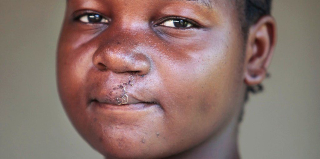一名来自坦桑尼亚的15岁女孩说，修复唇裂的手术让她重获新生。