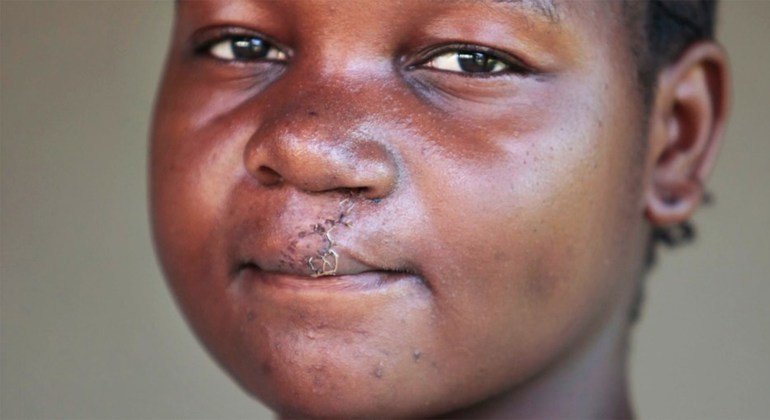 Abandonada por su padre al nacer, Agnes, del sudoeste de Tanzania, vivió por 15 años fuera de su comunidad debido a su aspecto.