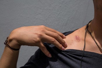 El estudiante de medicina Lobo*, de 21 años de edad, muestra las cicatrices de la violencia que dice haber soportado durante los disturbios en Nicaragua.
