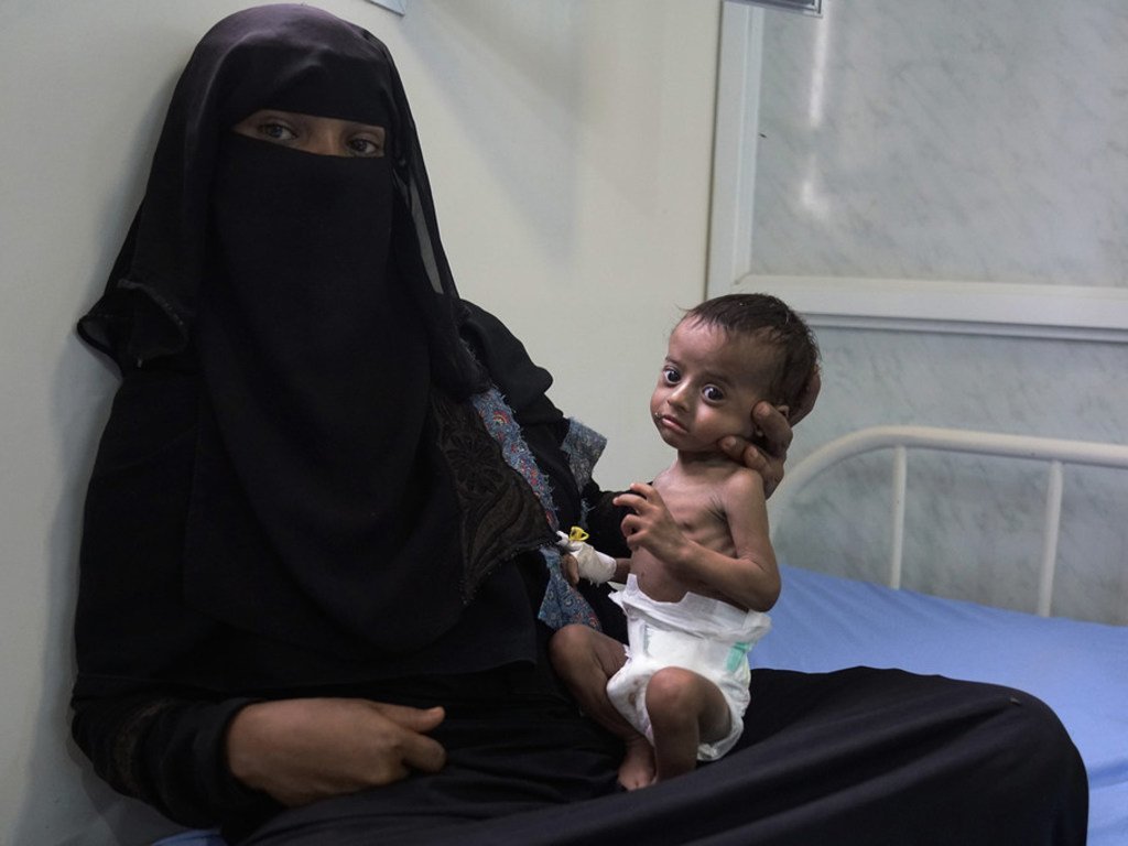 Saleh, âgé de quatre mois, admis dans le principal hôpital d'Hodeïda, avec sa mère Nora, en 2017. Des millions de personnes au Yémen sont menacées par la faim.