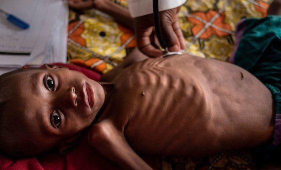Pacientes que chegam às enfermarias de nutrição do único hospital pediátrico do país reclamam de fome