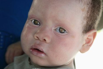 莫桑比克一名白化病幼儿。