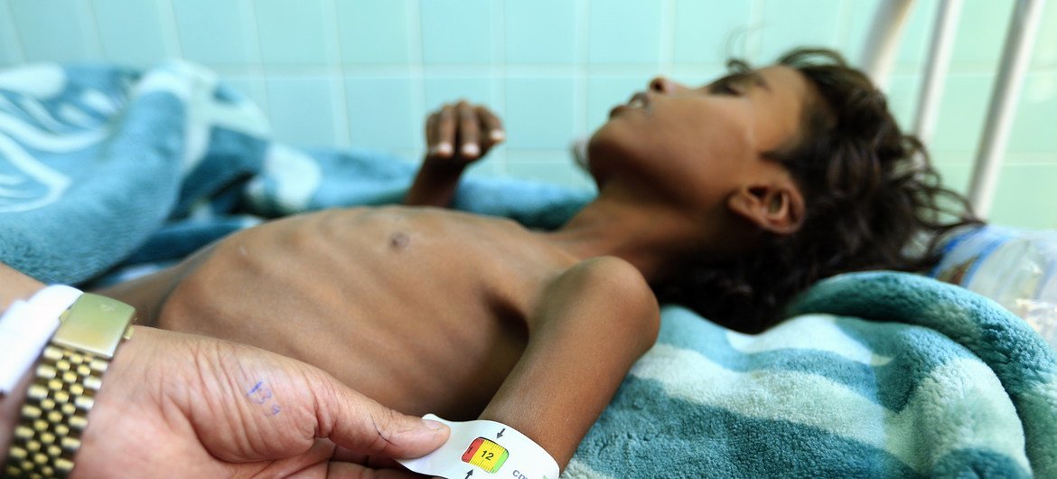 Un doctor mide el brazo de Ali Mohammed Ahmed Jamal, un niño de 12 años que ingresó por malnutrición en el hospital de Saná