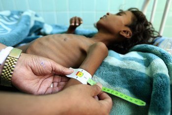 Dans un centre de traitement d'un hôpital de Sanaa, un médecin mesure le bras d'Ali Mohammed Ahmed Jamal, un Yéménite de 12 ans, souffrant de malnutrition. (Novembre 2018)