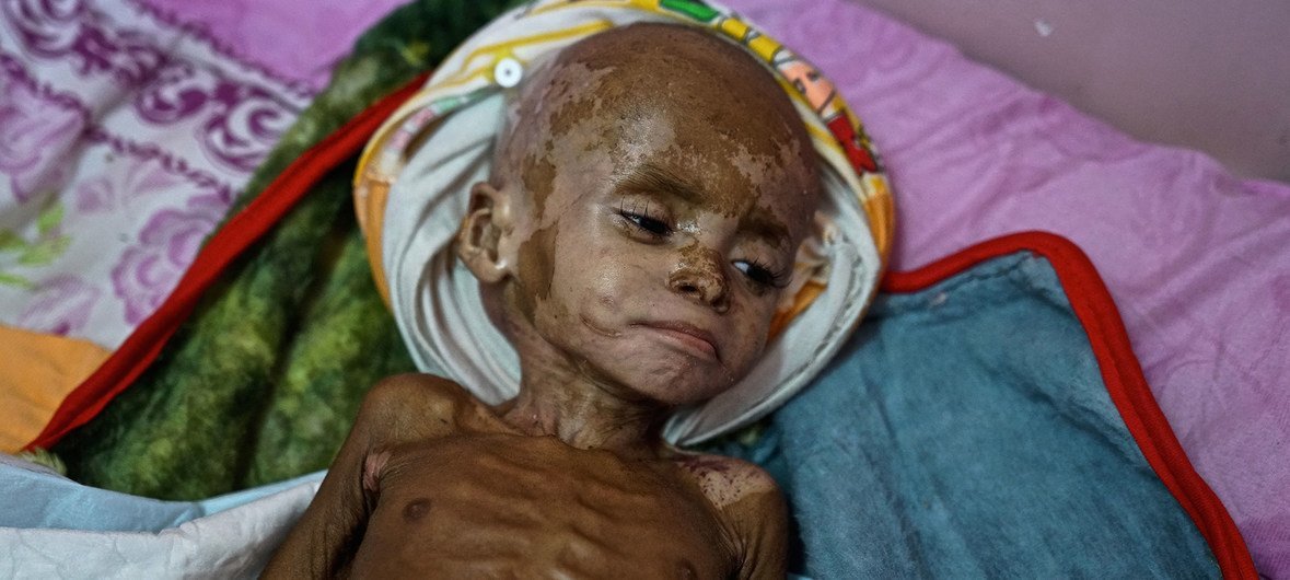 فواز - طفل يمني يعاني من سوء التغذية الحاد والشديد. الصورة له في مستشفى عدن باليمن في شهر نوفمبر 2018.