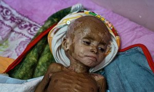 Fawaz, qui souffre de malnutrition aiguë sévère, à l'hôpital d'Aden. Novembre 2018.