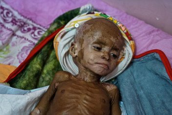 Fawaz sufre de malnutrición severa y se encuentra en un hospital de Aden, Yemen. 