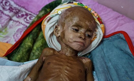 Fawaz, who suffers from severe acute malnutrition, in the hospital in Aden, Yemen. November 2018.