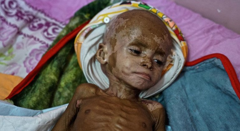 Mtoto Fawz anayeugua utapiamlo uliokithiri akipatiwa huduma kwenye hospitali ya Aden nchini Yemen Novemba 2018