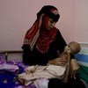 Fawaz, que sufre desnutrición aguda, y su madre en el hospital de Adén, en Yemen, en noviembre de 2018.