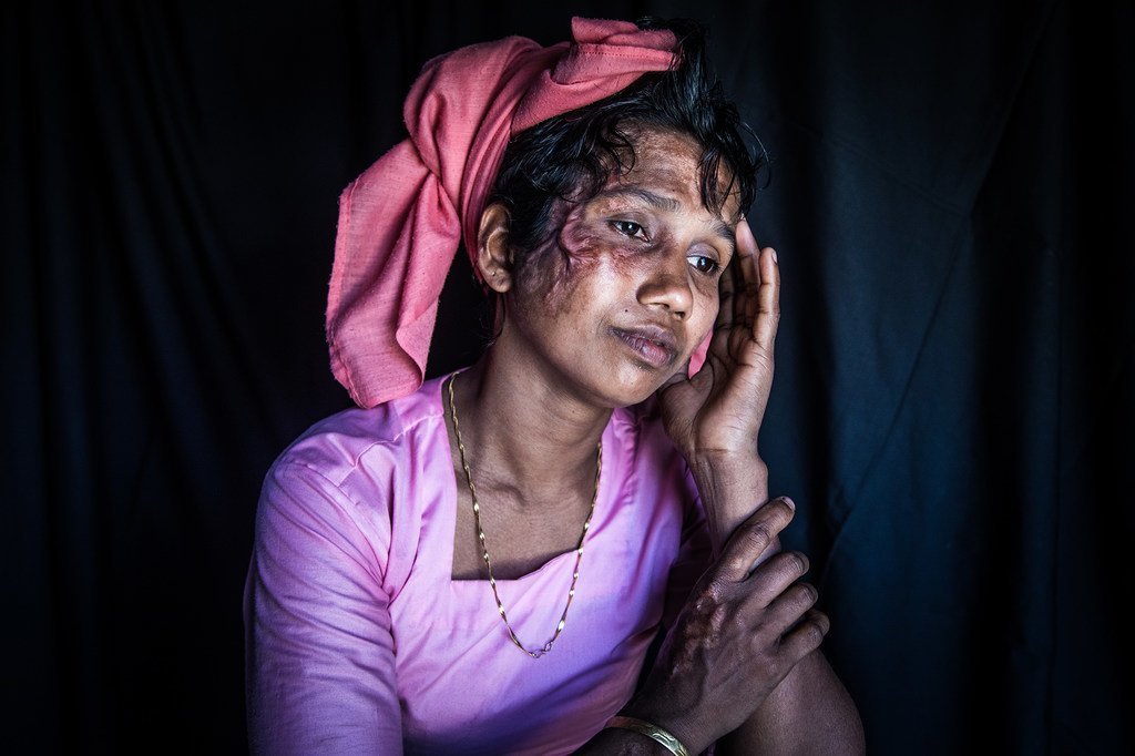 30岁的诺姆塔兹·贝古姆是一名来自缅甸的难民，现在在孟加拉国，她的两个孩子在她面前被杀。(2018年3月)
