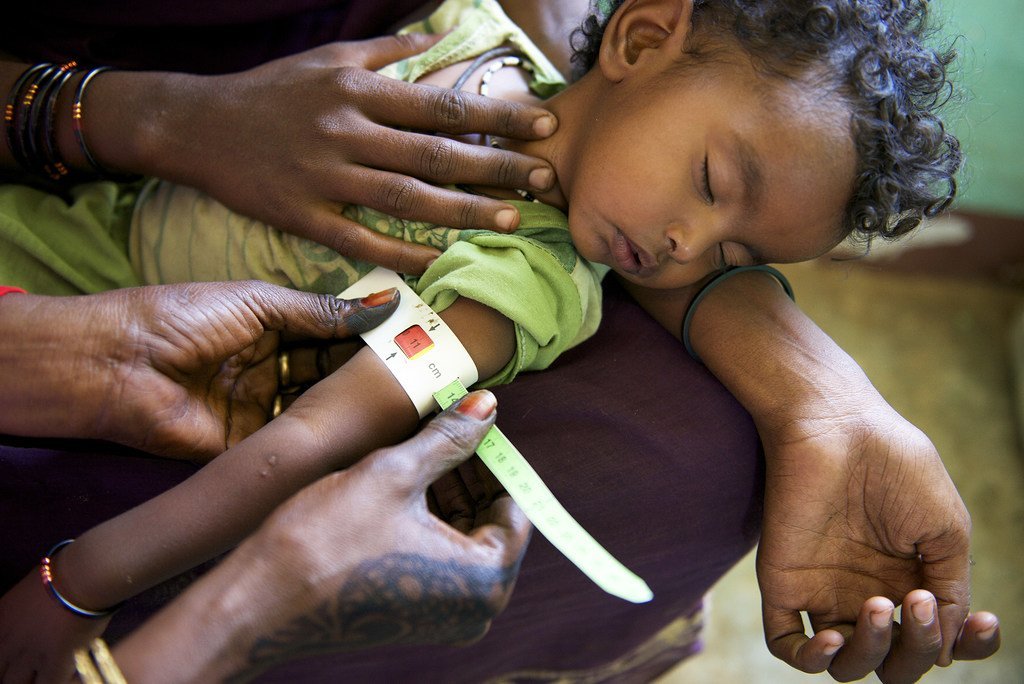 طفل يعاني من سوء التغذية في مركز للتغذية في كسلا ، السودان.