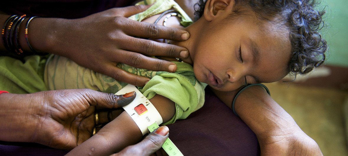 Un niño desnutrido recibe tratamiento en un centro nutricional en la ciudad de Kasala, al noreste de Sudán.