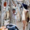 طفلة تعاني من سوء التغذية الحاد ومضاعفات الحمى والإسهال - الحديدة - اليمن.