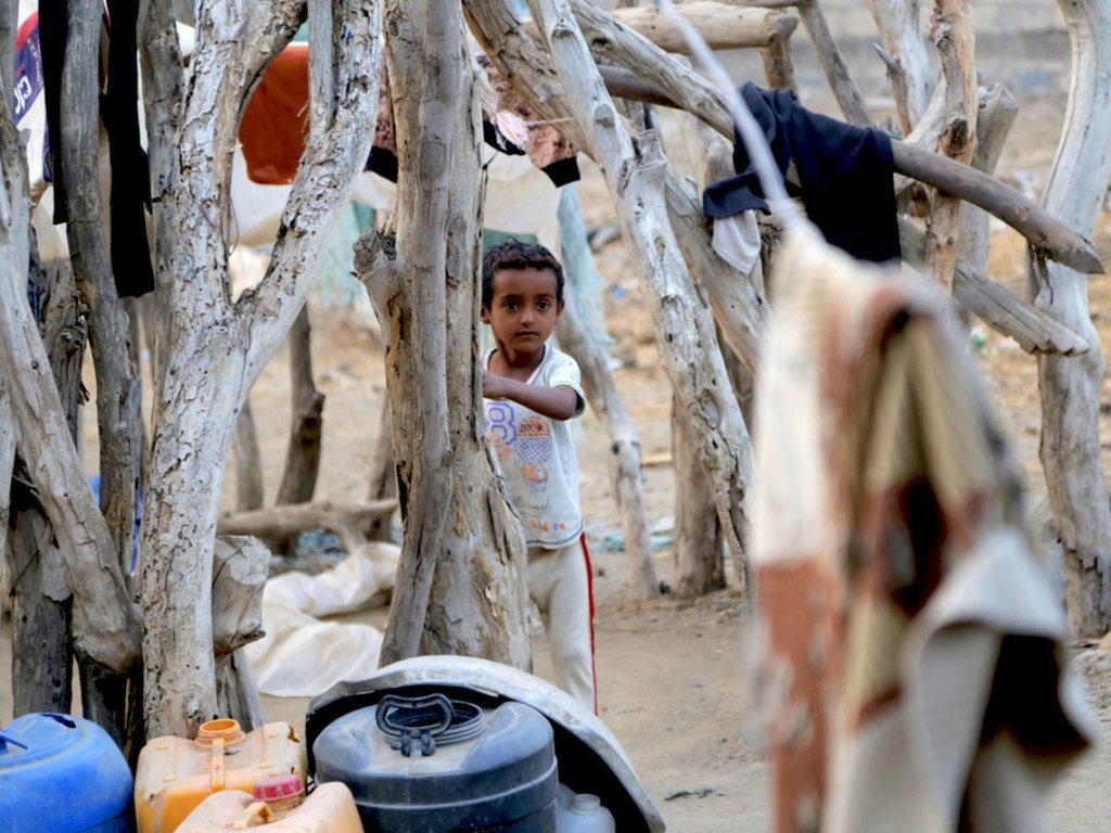 طفلة تعاني من سوء التغذية الحاد ومضاعفات الحمى والإسهال - الحديدة - اليمن.