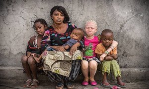 Les personnes touchées par l'albinisme sont souvent malvoyantes et ont besoin d'une protection spéciale contre le soleil. Elles développent souvent un cancer de la peau et souffrent de stigmatisation sociale, souligne l'UNICEF.