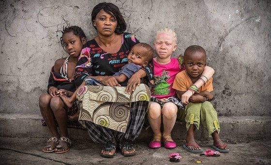 People affected by albinism are often visually impaired and need special protection against the sun. They often develop skin cancer and suffer from social stigmatization, according to UNICEF.