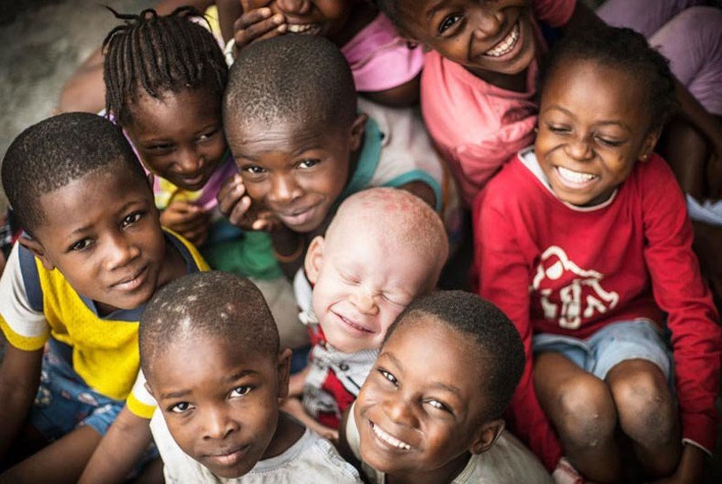 L'albinisme est une maladie héréditaire rare, non contagieuse, présente à la naissance. On la trouve chez les deux sexes, sans distinction d’origine ethnique, dans tous les pays du monde.