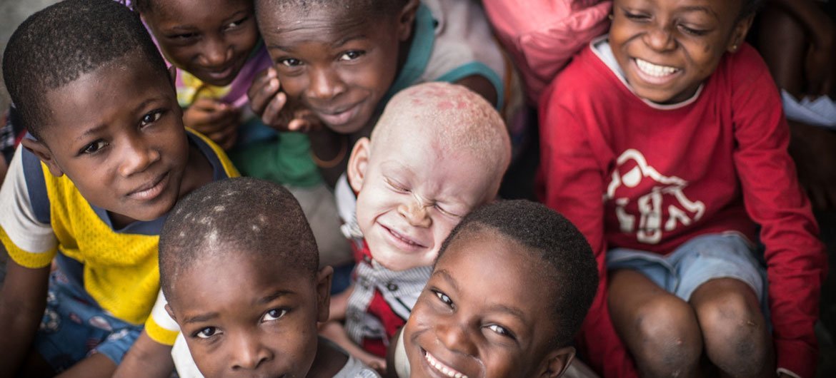 Albinism is a rare, non-contagious, genetically inherited condition present at birth. It is found in both sexes, regardless of ethnicity, in all countries of the world.