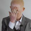 Embora não existam dados completos, a prevalência do albinismo é maior entre populações indígenas e afrodescendentes.