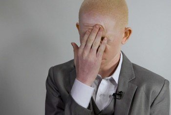 Embora não existam dados completos, a prevalência do albinismo é maior entre populações indígenas e afrodescendentes.